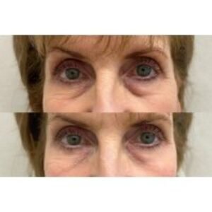 Polynucleotides Treatment - AesthetiSKN - Stoke-On-Trent | Wowcher