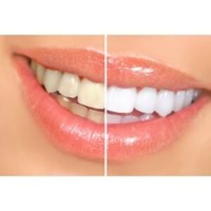 Zoom Teeth Whitening - Registered Professional - Derby City Centre | Wowcher