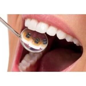 Lingual Dental Braces Treatment - One or Two Arch Upgrade at Dental Care London