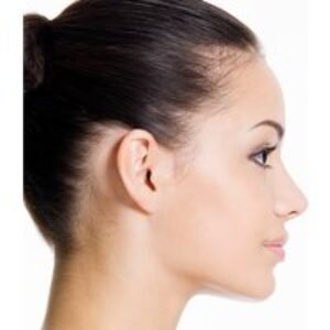 Non-Surgical Nose Job with Dermal Filler at Permanent Aesthetics Studio - 2 Locations