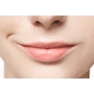 Lip Filler Dissolving Session at Glorious Skin Clinic