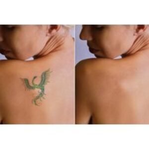 Laser Tattoo Removal - Choice of Area at 1118 IPL & Beauty Salon