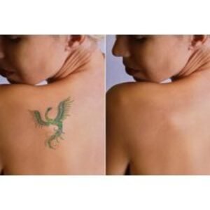 Laser Tattoo Removal - Up to 6 Sessions at LBL Aesthetics and Laser Ltd