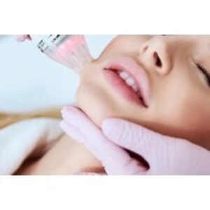 Skin Rejuvenation Microneedling Treatment with Michele Osmak Aesthetics - Cardiff | Wowcher